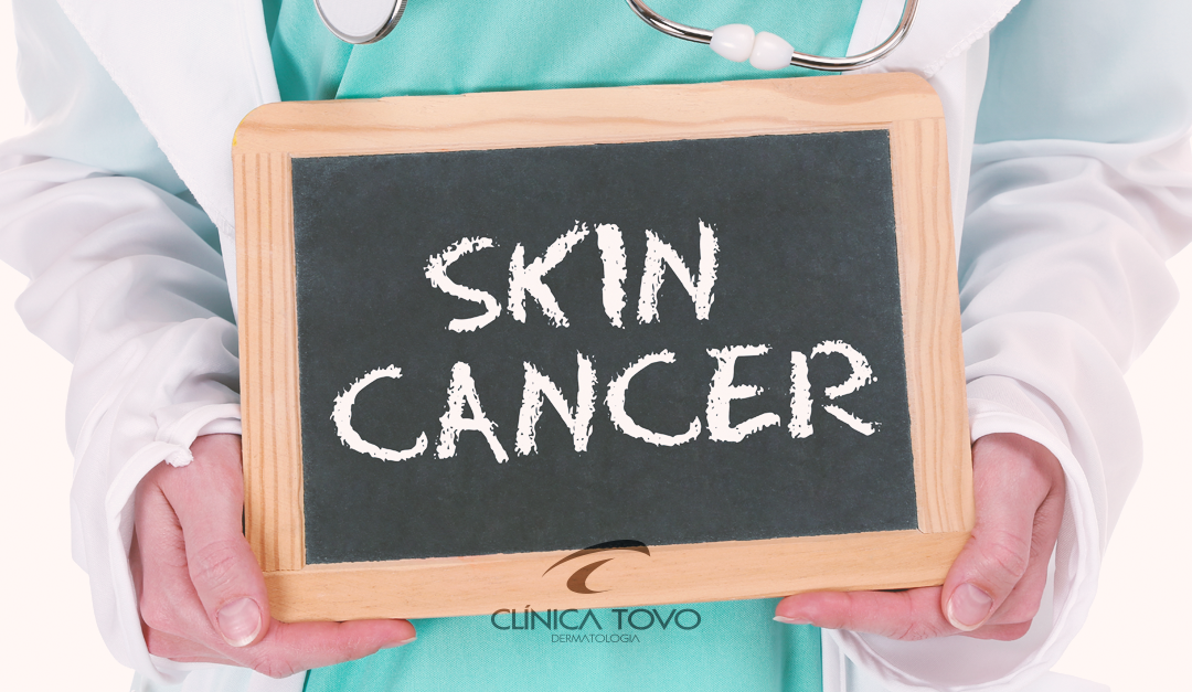Morte Por Câncer da Pele Cresce – Conheça as Técnicas de Prevenção e Tratamento
