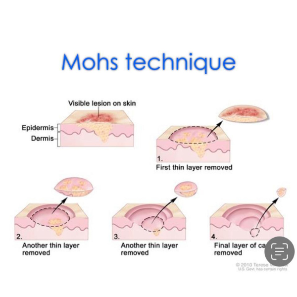cirurgia micrográfica de MOHS