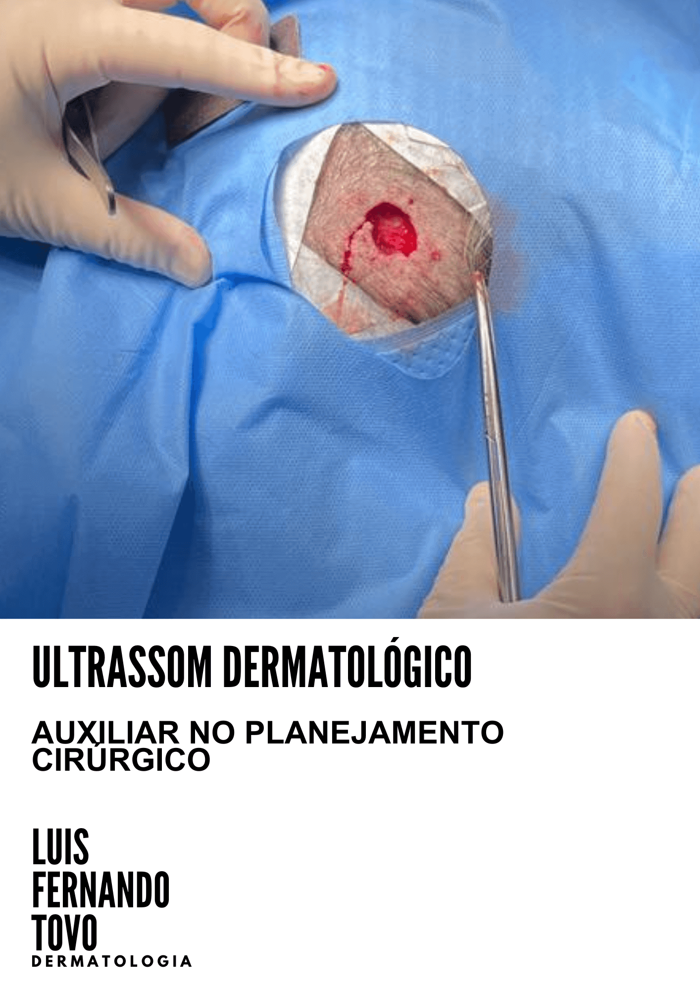 ultrassom da pele dr tovo luis fernando tovo clinica tovo dermatologia 1
