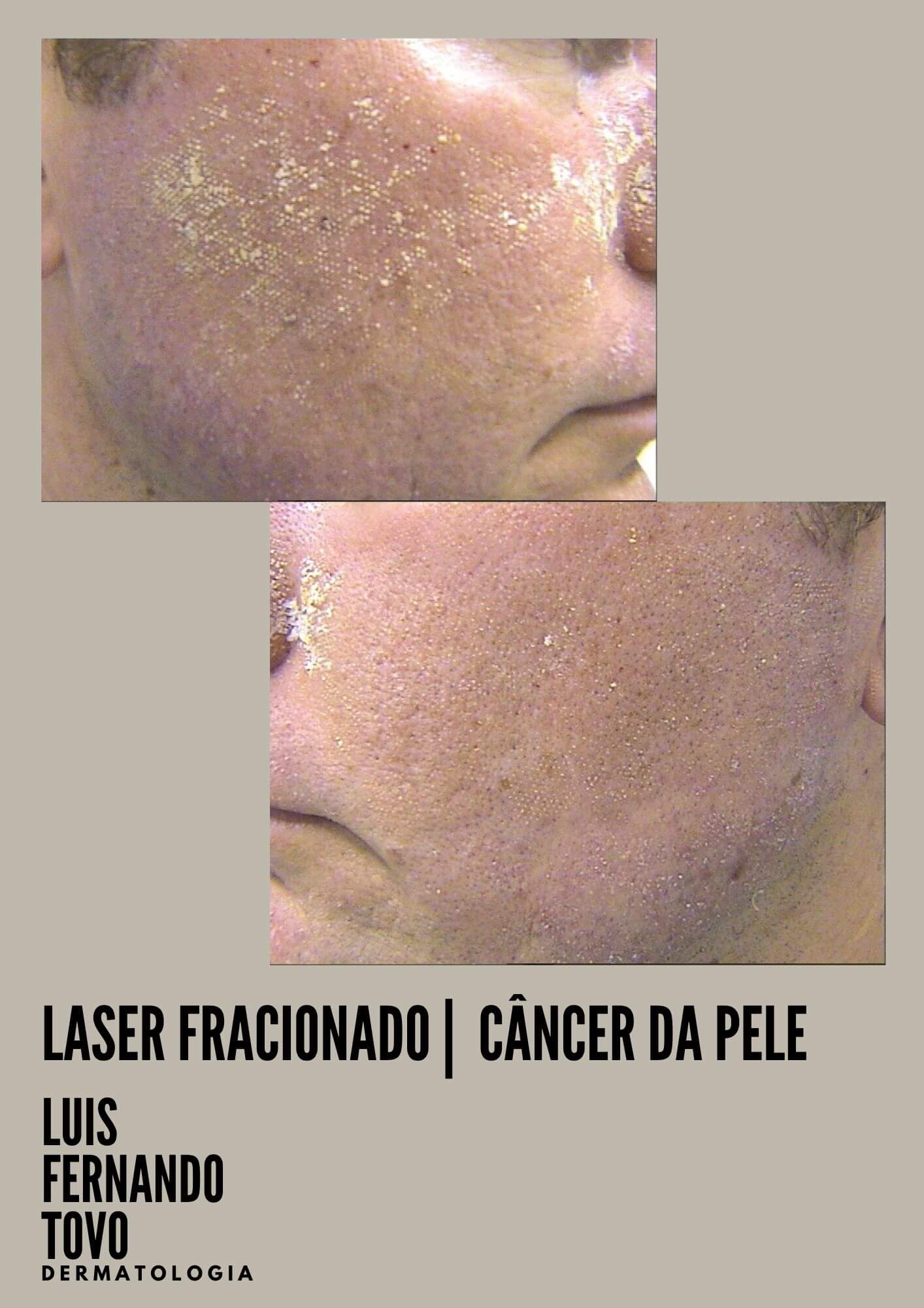 Dr Tovo laser e cancer da pele 