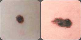 Comparação entre pinta simétrica normal e assimetria notável em câncer da pele