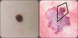 Comparação entre pinta normal e bordas irregulares notáveis em câncer da pele