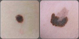 Comparação entre pinta normal e coloração diferente notável em câncer da pele