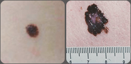 Comparação entre pinta com diâmetro normal e diferença notável em câncer da pele