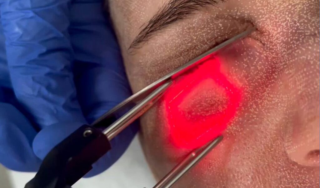 laser fracionado e prevenção de câncer de pele