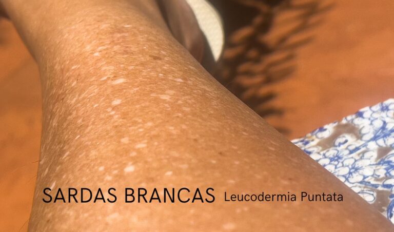 sardas brancas leucodermia puntata dr tovo dermatologista