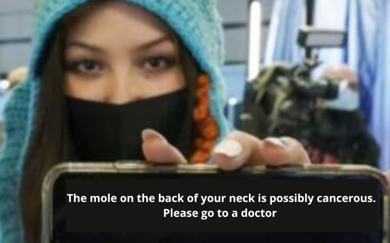 cancer de pele alerta clinica tovo