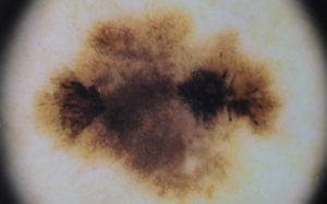 cancer de pele alerta e diagnostico precoce