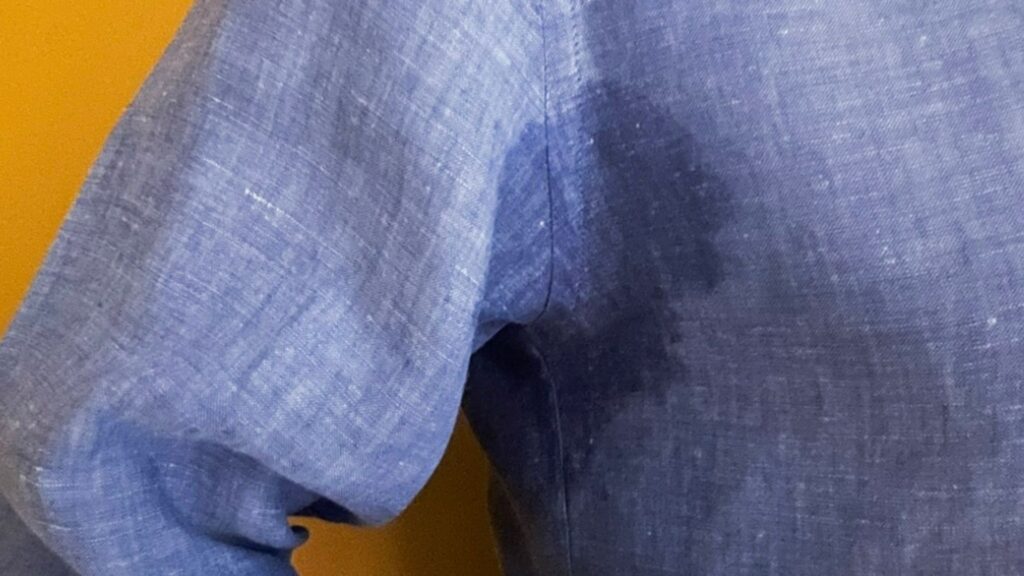 Botox nas axilas funciona? Como é Tratamento para Hiperidrose clinica tovo dr tovo dermatologista especialista