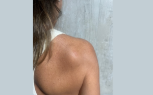 lipoma o que é e como tratar dr tovo luis fernando tovo clinica dr tovo de dermatologia