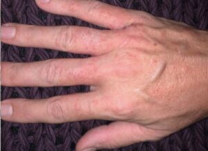 dermatite de mãos dr tovo clinica tovo telefone