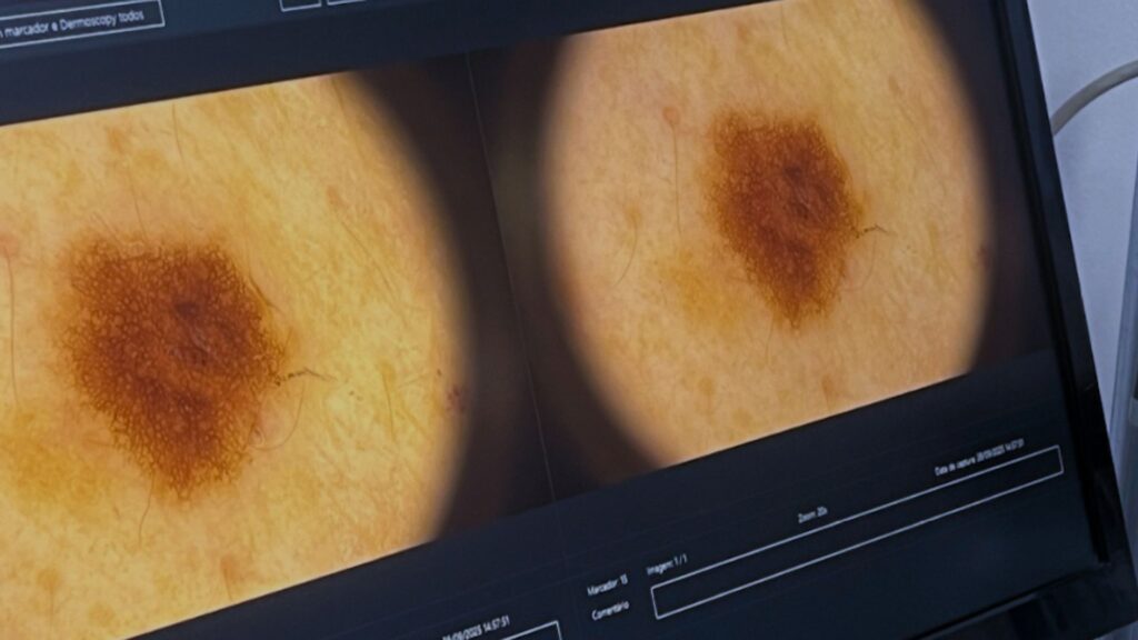 Diagnóstico e tratamento de câncer de pele clinica tovo em sâo paulo