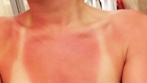 protetor solar uso ou não uso? clinica tovo