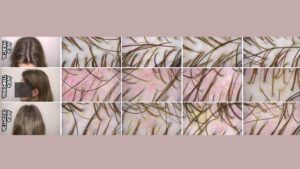 monjaro e queda de cabelo dr tovo dermatologista