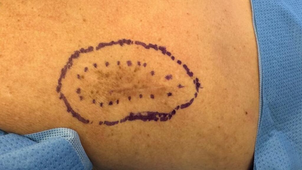 Duvidas sobre câncer de pele