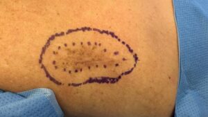 Duvidas sobre câncer de pele