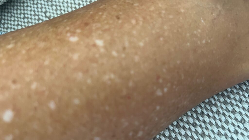 Sardas Brancas enfim uma opção de tratamento