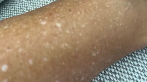 Sardas Brancas enfim uma opção de tratamento