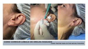 lobulo de orelha rasgado por brincos
