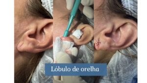 orelha lóbulo rasgado hospital sírio-libanês