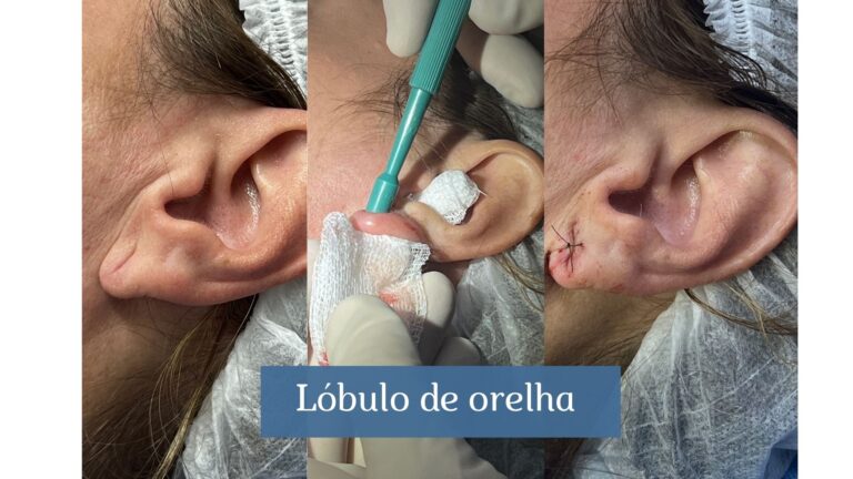 orelha lóbulo rasgado hospital sírio-libanês