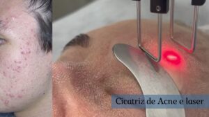 cicatriz de acne e laser