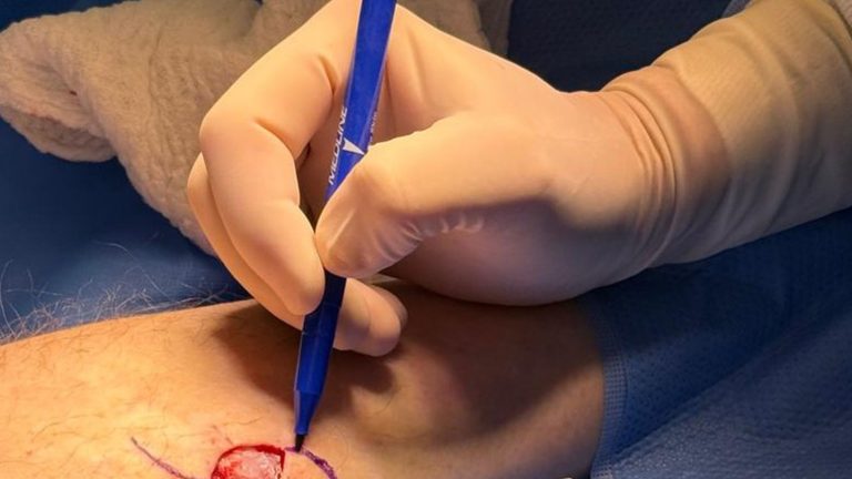 cirurgia de mohs