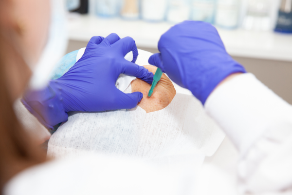 Médico dermatologista realizando procedimento de biópsia da pele