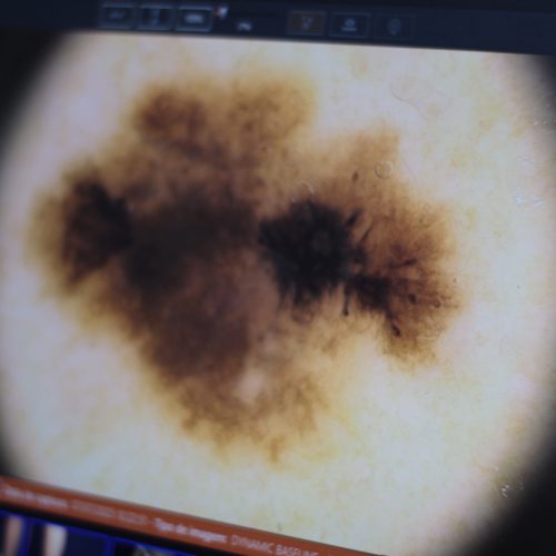 câncer da pele especialista dr tovo