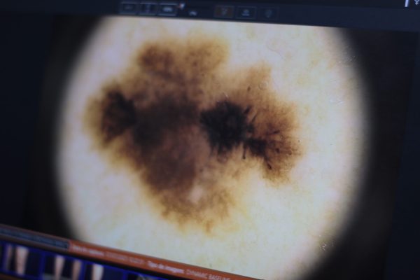 câncer da pele especialista dr tovo