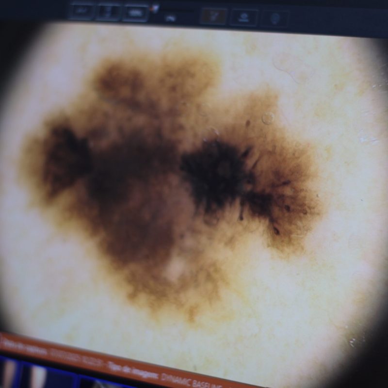 câncer da pele especialista dr tovo