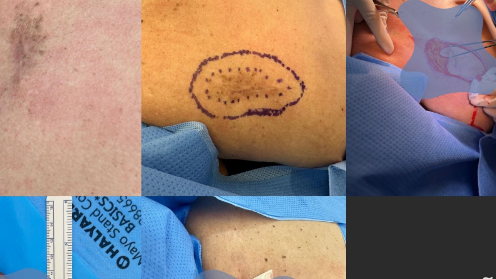 cancer de pele e celulas de merkel dermatologista sirio libanes