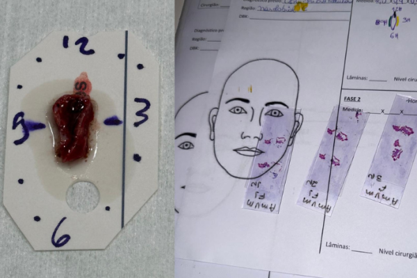 nucleooncologiacutaneacirurgiamohsdrtovodermatologista