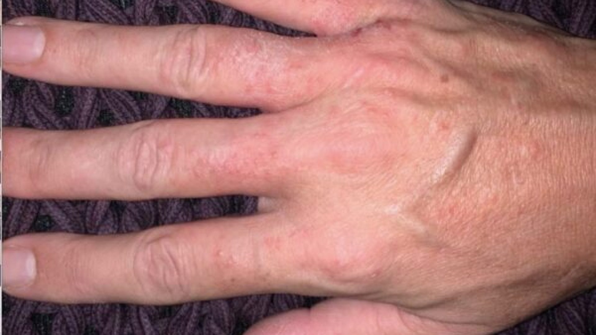 dermatite de mãos dr tovo clinica tovo telefone