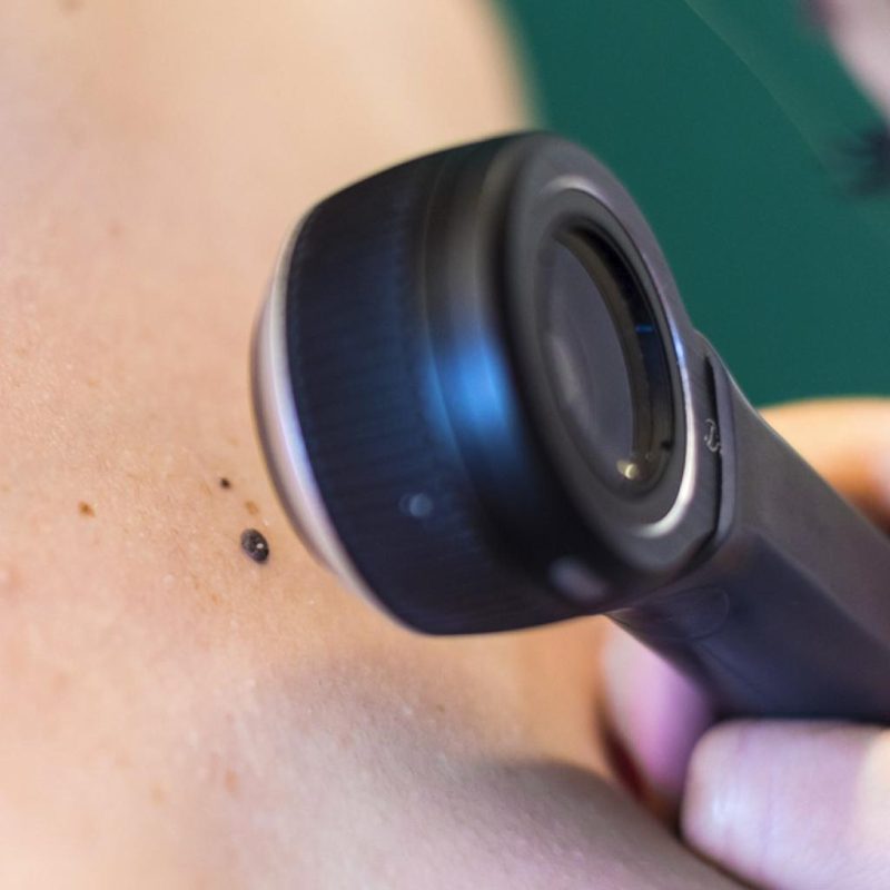 câncer da pele clinica tovo