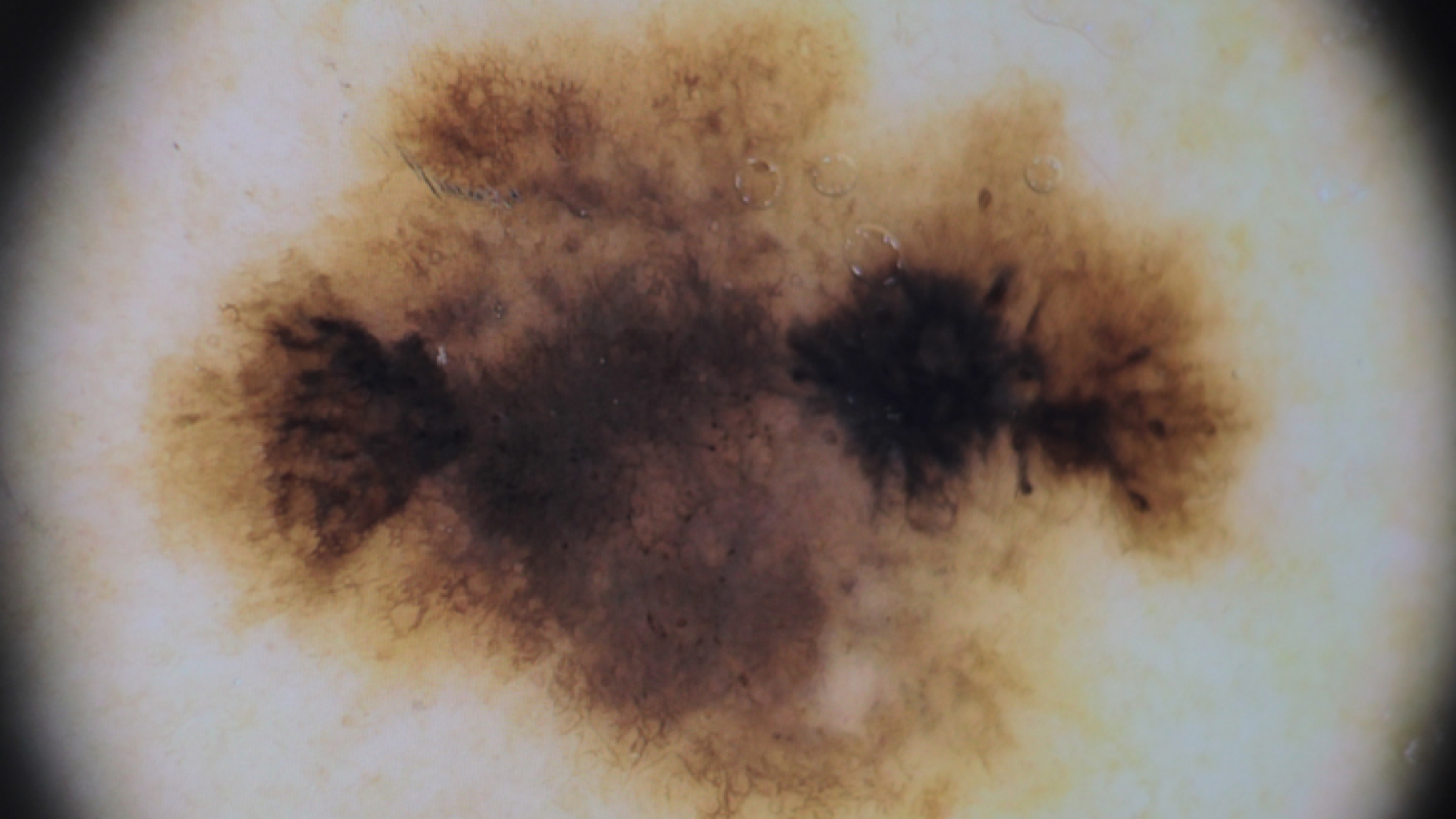 cancer de pele alerta e diagnostico precoce