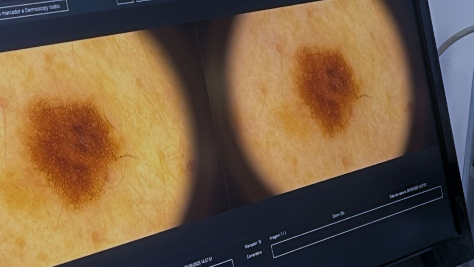 Diagnóstico e tratamento de câncer de pele clinica tovo em sâo paulo