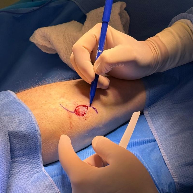 especialista em melanoma em são paulo