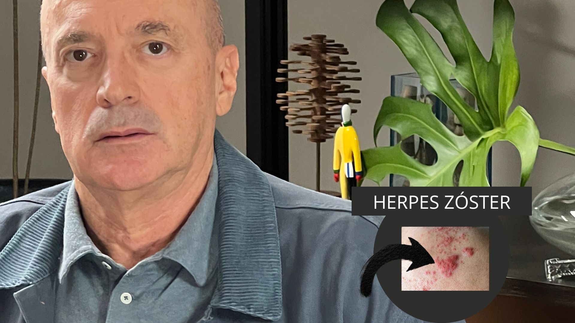 herpes zóster clinica tovo dr tovo dermatologista especialista