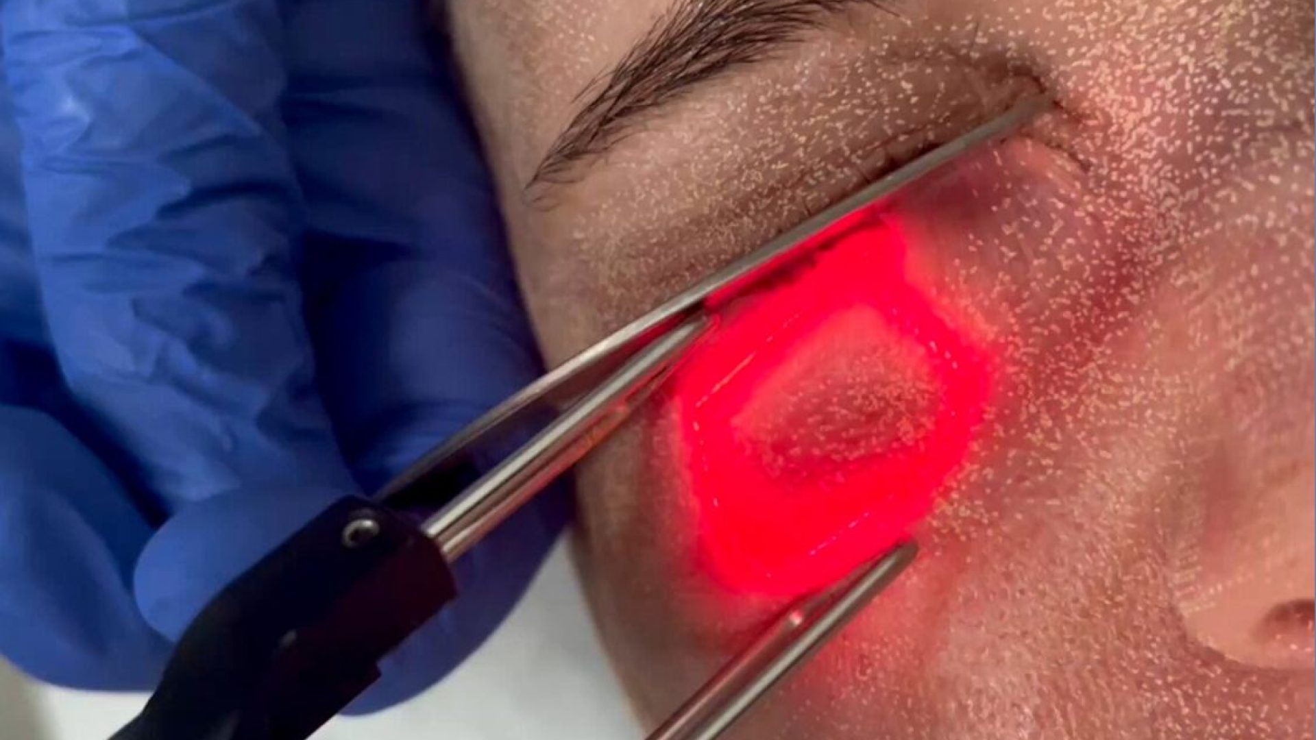 laser fracionado e prevenção de câncer de pele