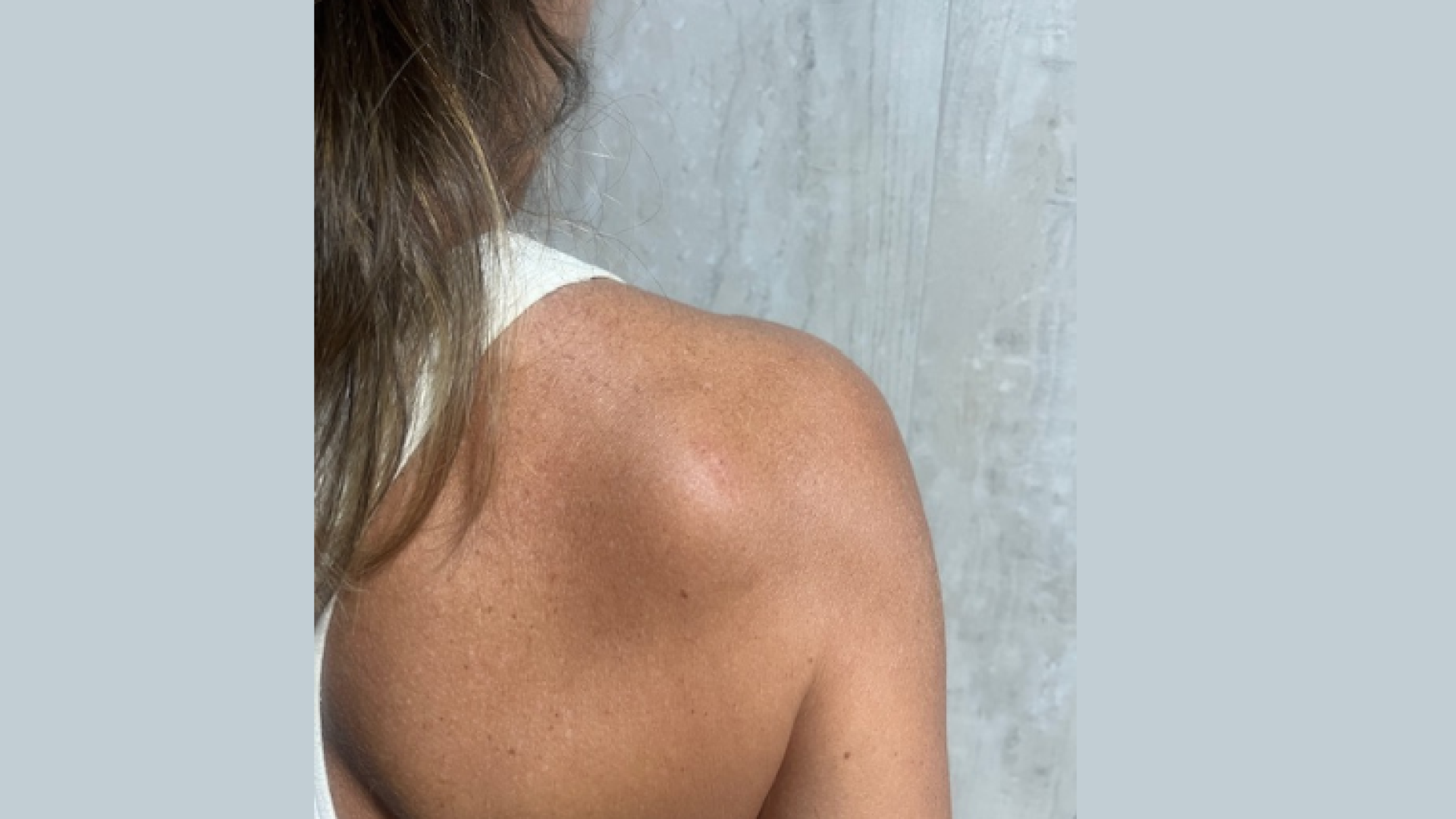 lipoma o que é e como tratar dr tovo luis fernando tovo clinica dr tovo de dermatologia