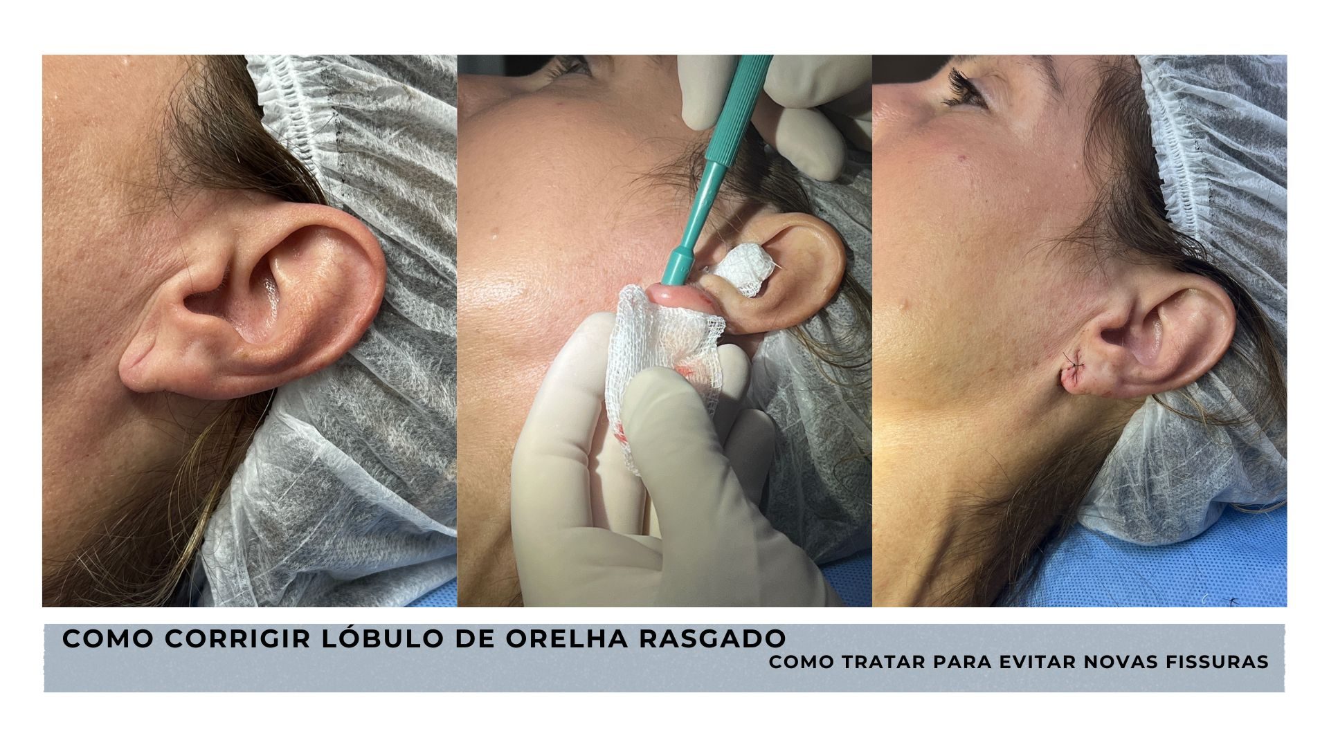 lobulo de orelha rasgado por brincos