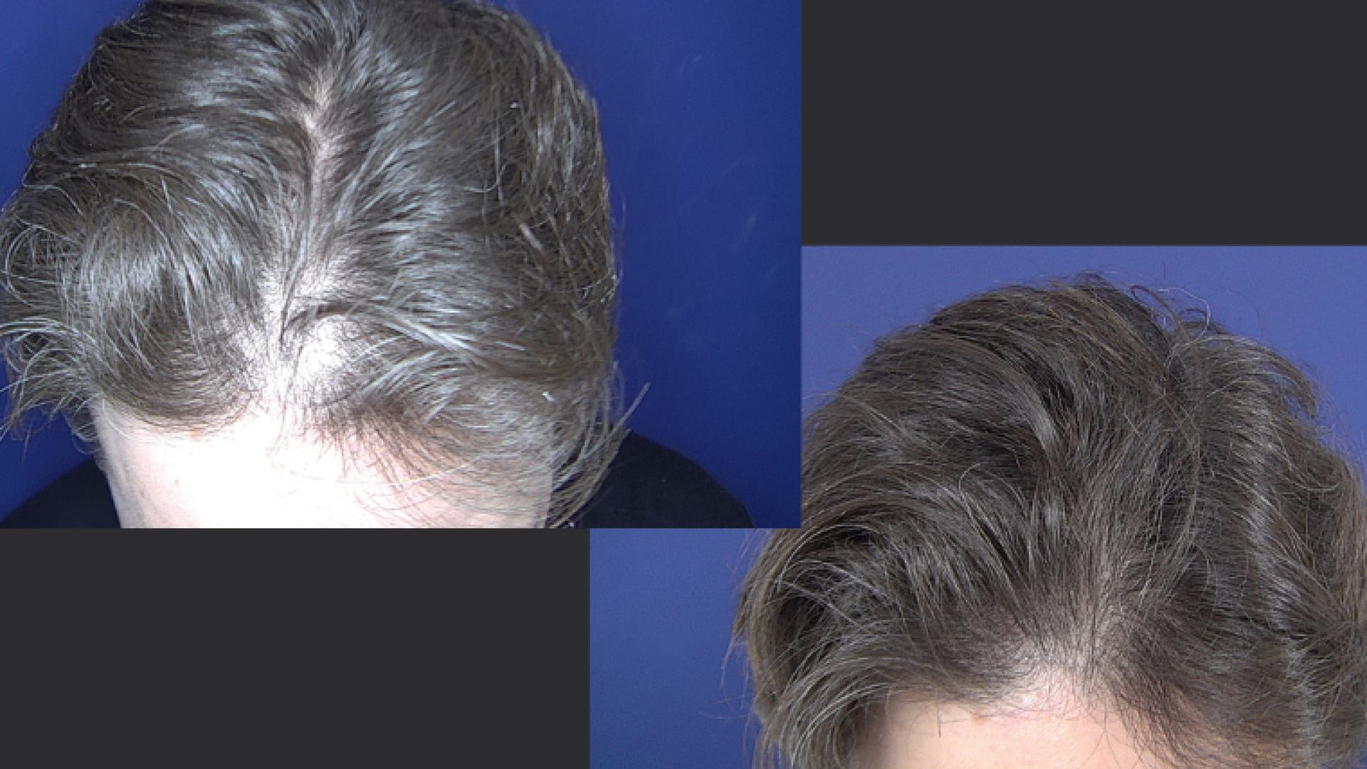 minoxidiloralresultadodrtovodermatologista