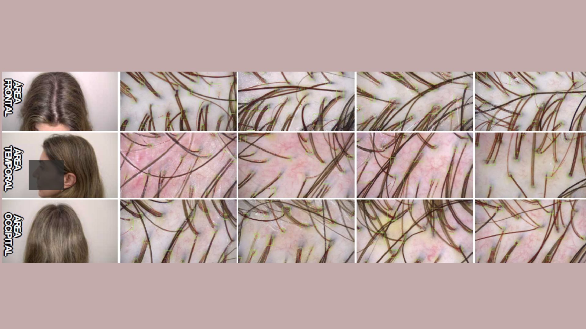 monjaro e queda de cabelo dr tovo dermatologista