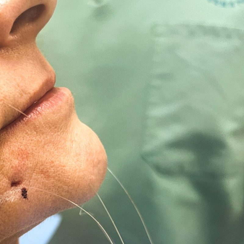 procedimentos estéticos fios de sustentação clinica tovo