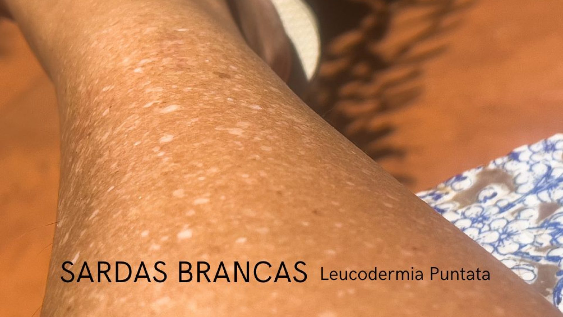 sardas brancas leucodermia puntata dr tovo dermatologista