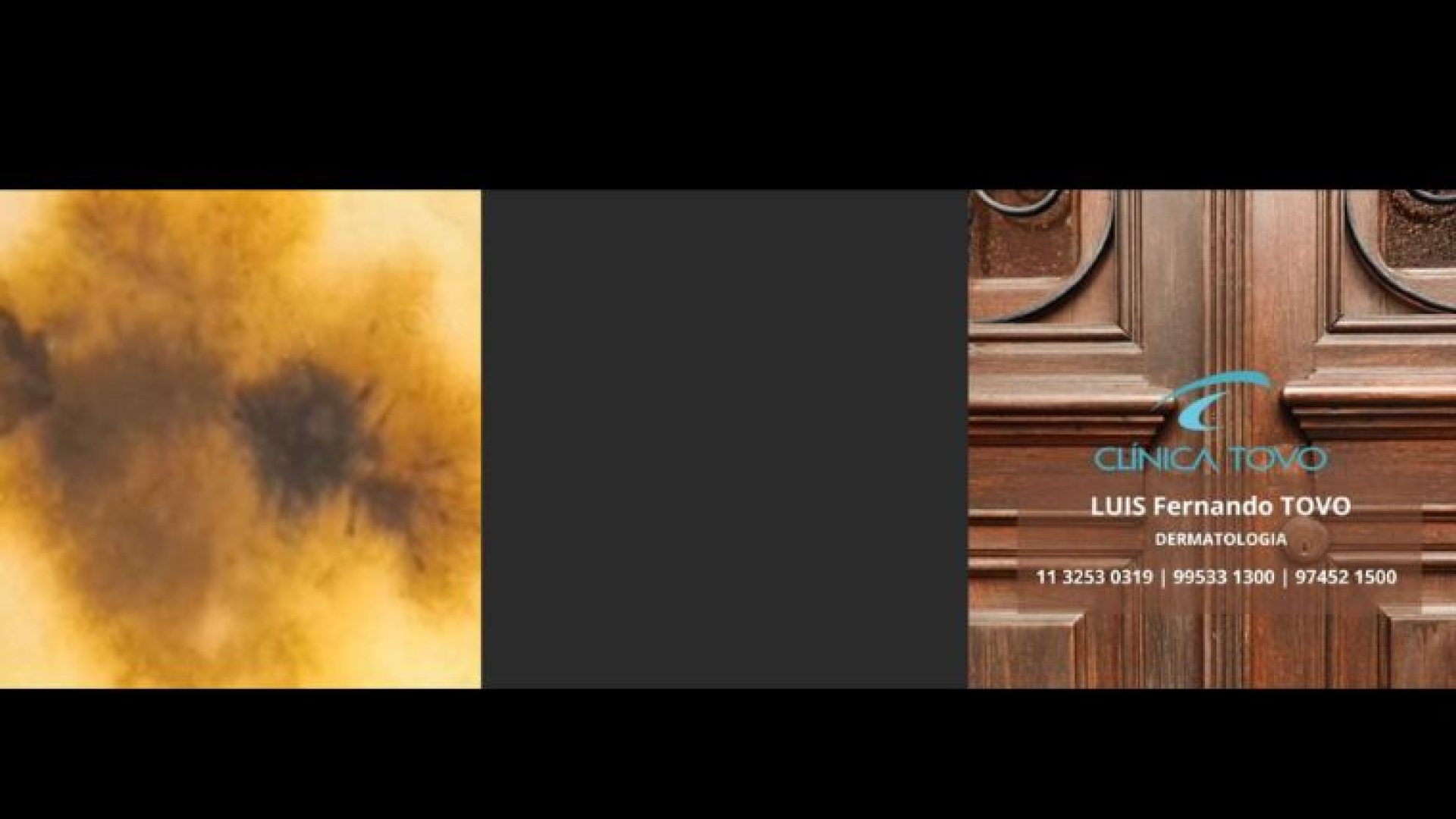 tipos de câncer de pele clinica tovo dr tovo